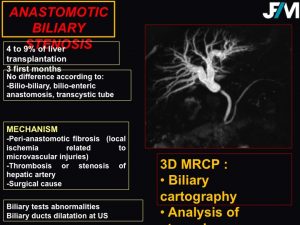 L ARRIVE Liver Transplantation JFIM Mumbai 2016