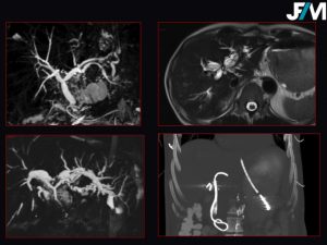 L ARRIVE Liver Transplantation JFIM Mumbai 2016