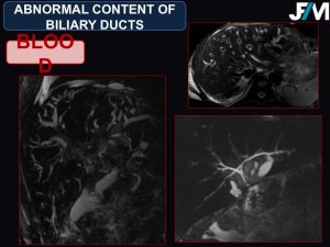 L ARRIVE Liver Transplantation JFIM Mumbai 2016