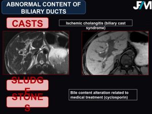 L ARRIVE Liver Transplantation JFIM Mumbai 2016
