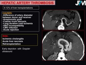 L ARRIVE Liver Transplantation JFIM Mumbai 2016