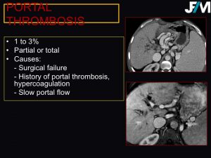 L ARRIVE Liver Transplantation JFIM Mumbai 2016