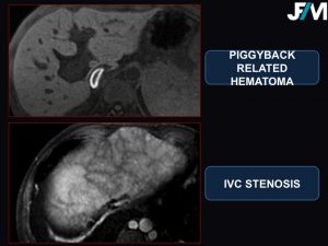 L ARRIVE Liver Transplantation JFIM Mumbai 2016