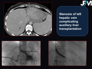 L ARRIVE Liver Transplantation JFIM Mumbai 2016
